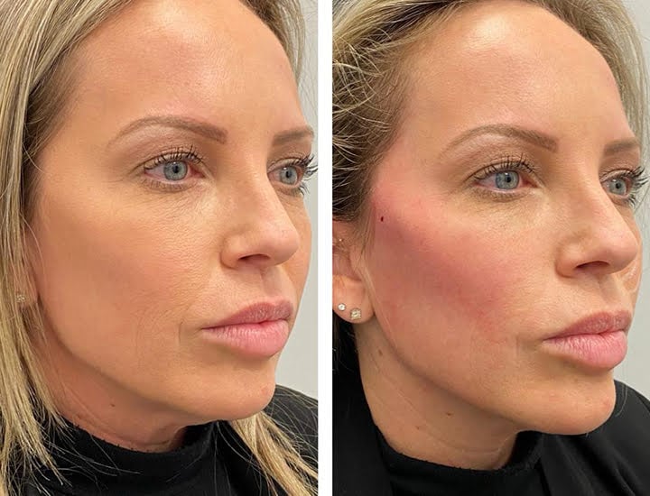 Martin's Treatments Silhouette InstaLift Threads