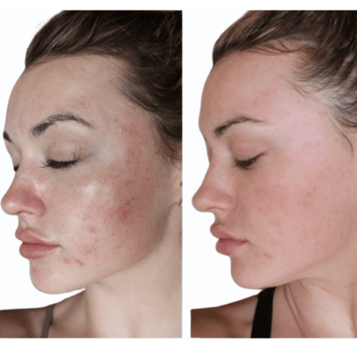 PRP Microneedling Before and After